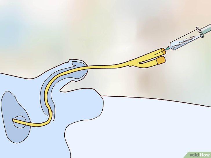 部分2 将导尿管插入膀胱